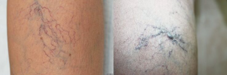 Symptoms of varicose veins