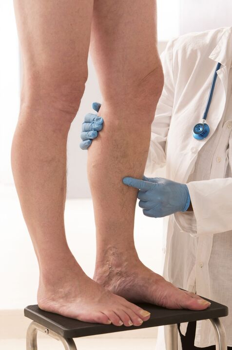 Varicosis what it is