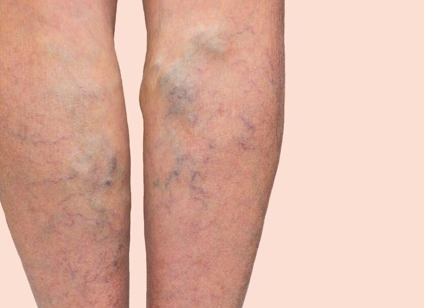 What a varicose veins