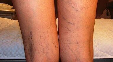 How to treat varicone expansion on women in women