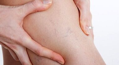 Signs and symptoms of varicose veins
