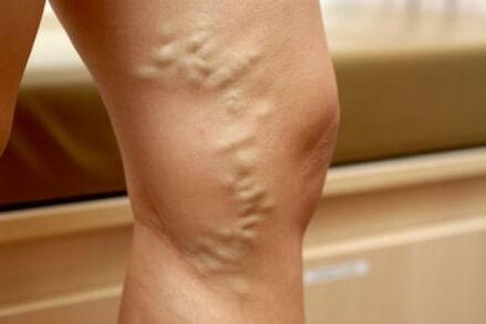 medications for varicose veins