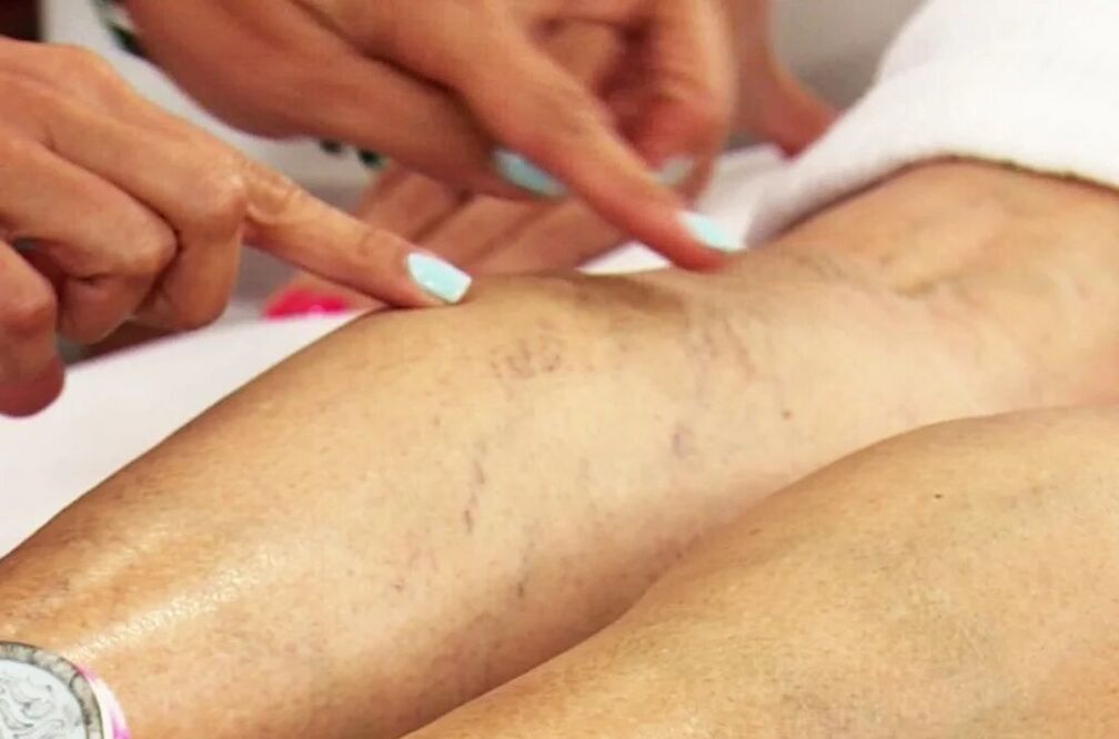 examination of the legs with varicose veins