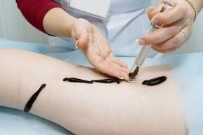 application of leeches for the treatment of varicose veins
