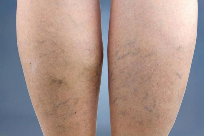 symptoms of varicose veins in the legs