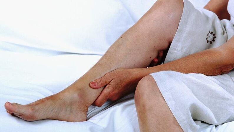 Woman suffering from varicose veins on legs