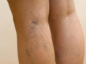 Veins protruding from under the skin are a symptom of varicose veins on the legs