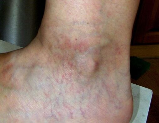 Manifestations of varicose veins of the lower extremities